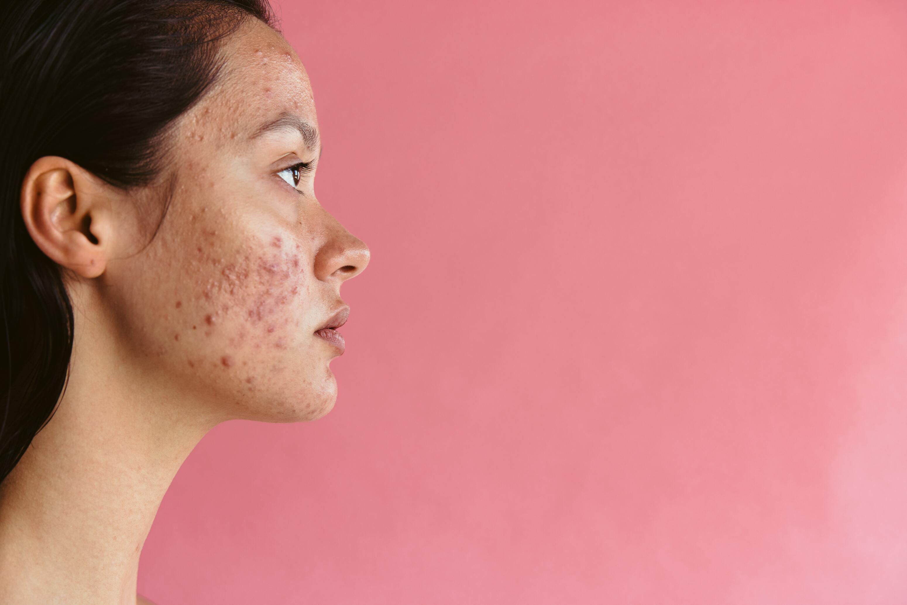 Acné inflammatoire : causes, traitements et conseils